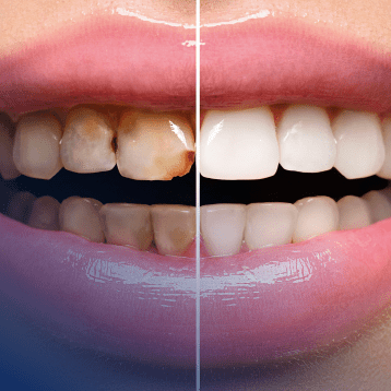 Restorative Dentistry | Acora Dental | General & Family Dentist | NW Calgary