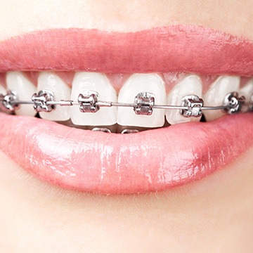 Braces | Acora Dental | General & Family Dentist | NW Calgary