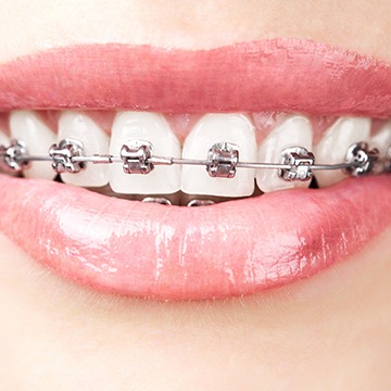Calgary Braces | Acora Dental | General & Family Dentist | NW Calgary