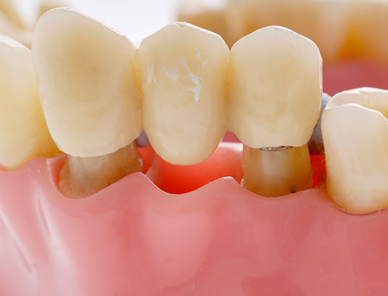 Dental Bridges | Acora Dental | General & Family Dentist | NW Calgary