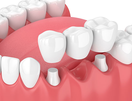 Dental Bridges | Acora Dental | General & Family Dentist | NW Calgary