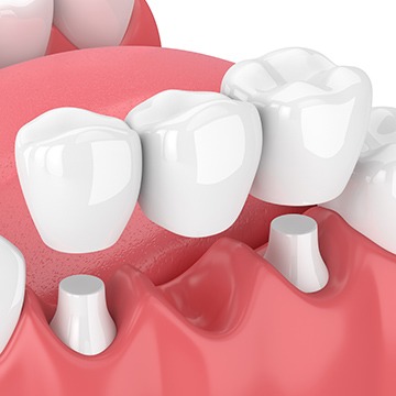 Dental Bridges | Acora Dental | General & Family Dentist | NW Calgary