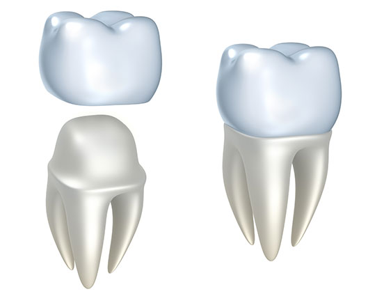 Dental Crowns | Acora Dental | General & Family Dentist | NW Calgary