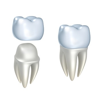 Dental Crowns Calgary | Acora Dental | General & Family Dentist | NW Calgary