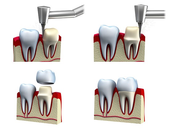 Dental Crowns | Acora Dental | General & Family Dentist | NW Calgary