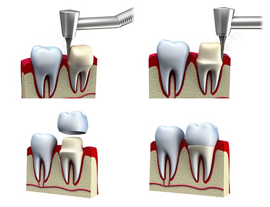 dental-crowns-service-acora-dental-general-and-family-dentist-nw-calgary Calgary Dental Crowns | Acora Dental | General & Family Dentist | NW Calgary