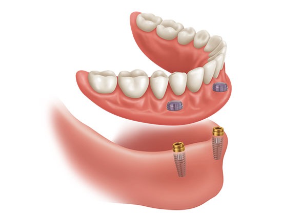 Dentures | Acora Dental | General & Family Dentist | NW Calgary