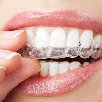 Invisalign® | Acora Dental | General & Family Dentist | NW Calgary