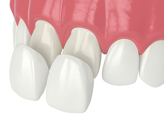 Porcelain Veneers | Acora Dental | General & Family Dentist | NW Calgary