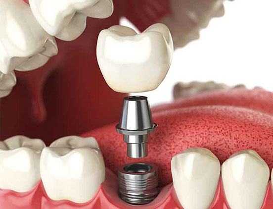 Restorative Dentistry | Acora Dental | General & Family Dentist | NW Calgary