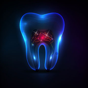 Root Canal Therapy | Acora Dental | General & Family Dentist | NW Calgary