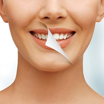 Teeth Whitening | Acora Dental | General & Family Dentist | NW Calgary