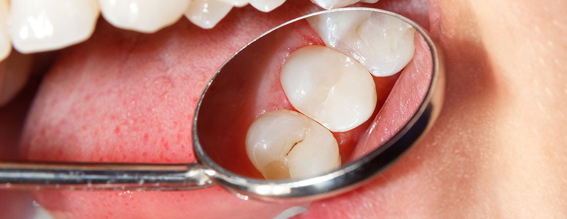 tooth-coloured-filling-service-acora-dental-general-and-family-dentist-nw-calgary Calgary Tooth Coloured Fillings | Acora Dental | General & Family Dentist | NW Calgary