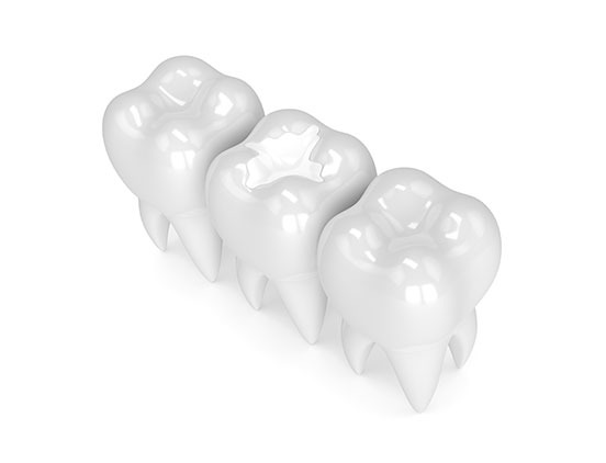 tooth-coloured-fillings-acora-dental-general-and-family-dentist-nw-calgary Calgary Tooth Coloured Fillings | Acora Dental | General & Family Dentist | NW Calgary