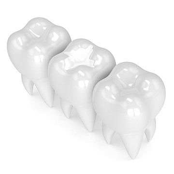 White Coloured Fillings | Acora Dental | General & Family Dentist | NW Calgary