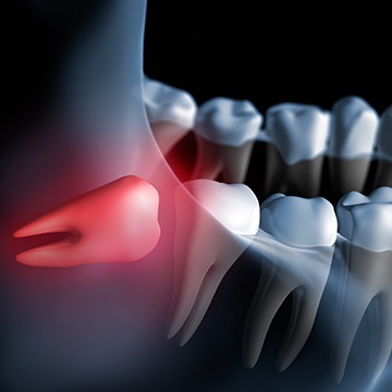 Calgary Wisdom Teeth Extractions | Acora Dental | General & Family Dentist | NW Calgary